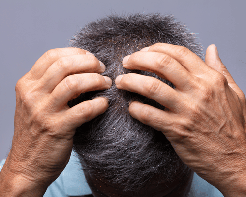 Men's Dandruff and Hair Fall Treatment Salon in Siruseri Chennai